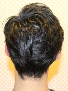 フェイスラインのカバー術